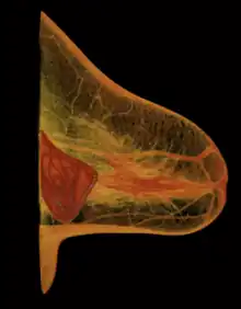 Implant rupture visualized by Breast-Computertomography