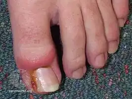 In-growing nail with granuloma formation aggravated by an oral retinoid