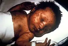 Infant with skin lesions from congenital rubella (blueberry muffin lesions)