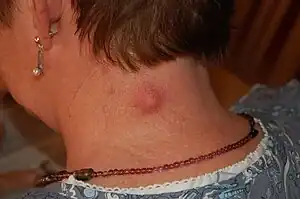 Epidermal cyst on the neck, inflamed