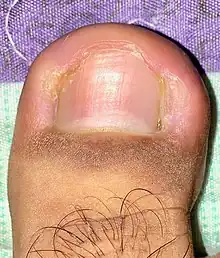 Ingrown nail in the big toe