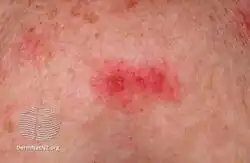 Insect bite