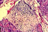 A histological image of an inflammatory infiltration of the islets of Langerhans of the pancreas