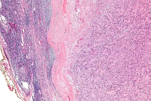 Low mag.Intranodal palisaded myofibroblastoma