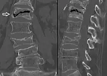 The intravertebral vacuum cleft sign (white arrow) is a sign of avascular necrosis. (Avascular necrosis of a vertebral body after a vertebral compression fracture is called Kümmel's disease.)