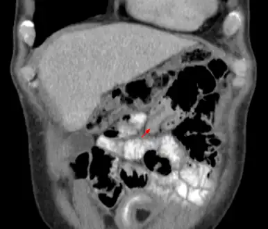 Small intestinal invagination on computed tomography