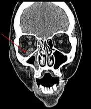 CT head (coronal) of same person.