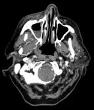 CT head (axial): invasion of right maxillary sinus (presented with double vision, swollen painful eye).