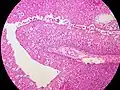 Inverted Schneiderian Papilloma of the Nasal Cavity with Abundant intraepithelial microabscesses.