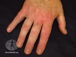 Irritant contact dermatitis