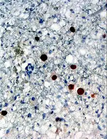 Immunohistochemical detection of "Human polyomavirus 2" protein (stained brown) in a brain biopsy (glia demonstrating progressive multifocal leukoencephalopathy (PML))