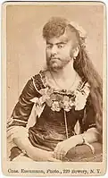 Photo of Annie Jones, a bearded lady, taken by Charles Eisenmann around 1900. The cause of Jones' hypertrichosis remains unknown.