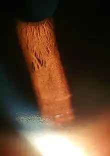 Copper deposition on corneal Descemet's membrane