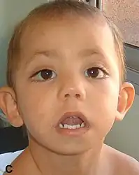 Child displaying typical facial phenotype of Kabuki syndrome