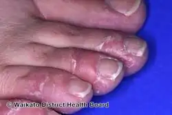 Keratolytic winter erythema