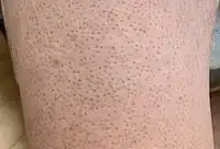 Keratosis pilaris on lower leg