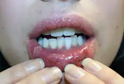 Affecting mouth