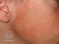 Keratosis pilaris face