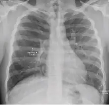 Chest x-ray showing Kerely B line due to interstitial oedema (in children only) of primary pulmonary tuberculosis.