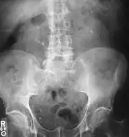 Bilateral kidney stones can be seen on this KUB radiograph. There are phleboliths in the pelvis, which can be misinterpreted as bladder stones.
