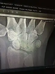 X-ray showing stage IIIB on right wrist, with ulnar impingement.