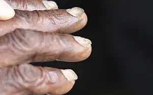 Koilonychia (spoon-shaped nails)