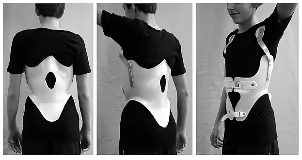 Modern brace for the treatment of a thoracic kyphosis. The brace is constructed using a CAD/CAM device.
