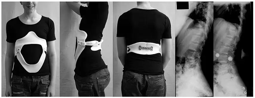 Modern brace for the treatment of lumbar or thoracolumbar kyphosis. The brace is constructed using a CAD/CAM device. Restoration of the lumbar lordosis is the main aim.
