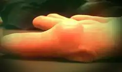 Cyst on a finger