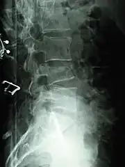 Compression fracture of the fourth lumbar vertebra post falling from a height.