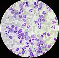 Chronic myeloid leukemia in a 4 years old female. Peripheral blood (MGG stain)