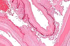 Micrograph showing the characteristic laminated cyst wall.H&E stain.
