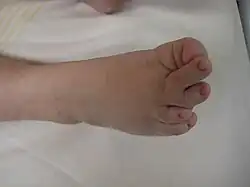 The right foot of a person with Langer–Giedion syndrome showing the characteristic features