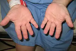 Hands of a person with Langer–Giedion syndrome showing the characteristic short fingers