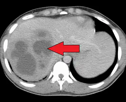 A large pyogenic liver abscess presumed to be the result of appendicitis