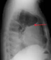 A pleural effusion as seen on lateral upright chest x ray