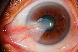 Large primary pterygium invading the pupil (visual axis)