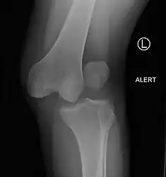 A lateral dislocation of the knee