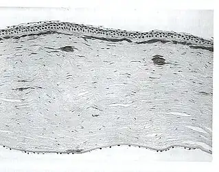 Lattice corneal dystrophy type II. Black and white light micrograph showing deposits of amyloid in cornea. Congo red stain.
