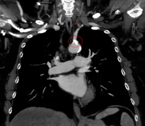 CT angiography of subclavian steal phenomenon