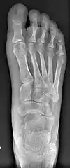 Left big toe joint shifted in sideway due to overcorrection