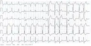 Electrocardiogram showing left bundle branch block and irregular rhythm due to supraventricular extrasystoles.