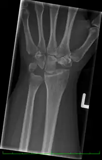Left hand x-ray post proximal row carpectomy