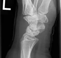 Left hand x-ray with Kienbock's Disease