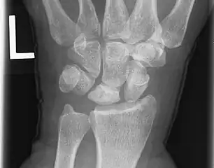 Left hand x-ray with Kienbock's Disease showing 4 mm negative ulnar variance and Kienbock's Disease Stage IIIB