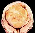 A relatively large submucosal leiomyoma; it fills out the major part of the endometrial cavity
