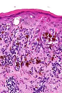 Light microscopy of lentigo maligna showing the characteristic atypical epidermal melanocytes. H&E stain.