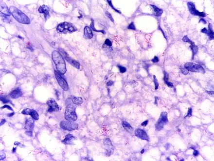 Modified AFB staining in a case of lepromatous leprosy showing numerous rod shaped acid fast bacilli