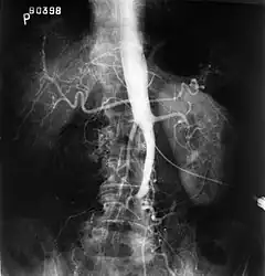 Fluoroscopic image of an affected aorta