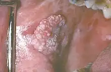 Exophytic leukoplakia on the buccal mucosa